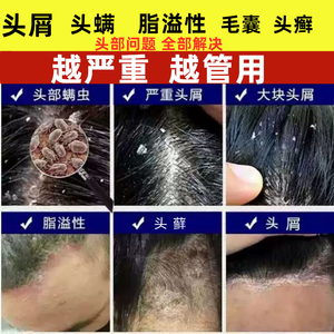 去头癣治疗头部牛皮藓头皮屑真菌感染洗发水毛炎银囊屑病止痒药膏