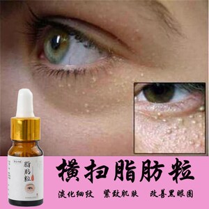 汗粒清脂肪粒去除神器眼部除油脂粒工具汗管粒专用膏非日本眼霜药