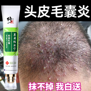 头皮毛囊炎的药膏