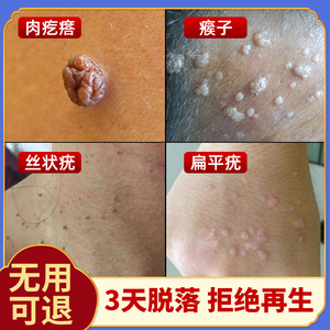 去除正品去猴子肉粒疙瘩鱼鳞痣非药祛瘊子神器休子专用肉刺膏tb