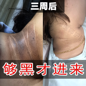 颈部黑棘皮脖子黑洗不干净色素沉着去除产后腋下男女美白祛黑关节