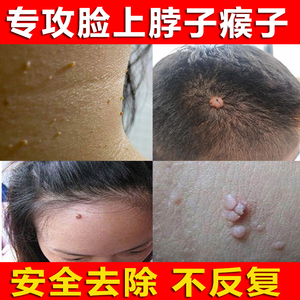 脸上去猴子肉刺膏