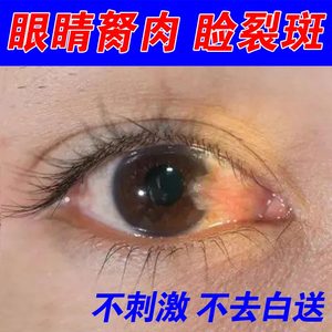 中老年人眼睛胬肉眼药水去除睑裂斑治眼黄斑视力模糊红血丝滴眼液