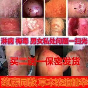 003人付款淘宝治疗淋病性病一扫光包皮炎龟头炎梅毒男女性病克星喷剂