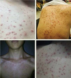 身体头皮囊炎穿掘性毛囊前胸后背部马拉色菌炎疙瘩药水