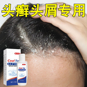 头痒有疙瘩毛囊炎治顽固性皮癣皮痒头癣药膏治头部银屑专用洗发水