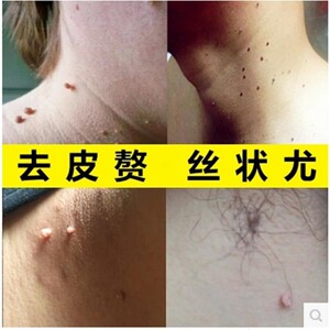 斑蟊素丝状疣脖子扁平肉粒腋下石疣趾疣去除疣立净乳膏班蝥素正品
