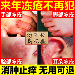 冻疮药膏治神器的预防冻伤修复护手霜宝王耳朵手脚宝专用一抹消灵