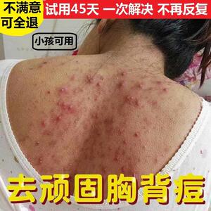 除螨皂后背背上长痘痘去螨虫抑菌全身沐浴肥皂香皂男女士杀菌祛痘
