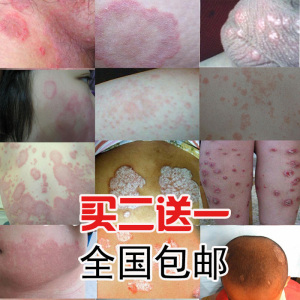 苗家牛皮癣药膏复方黄柏祛癣搽剂银屑廯病止痒外用瘙痒专用皮肤治