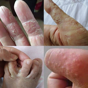 汗孢状疱疹专用苗家水泡鹅掌风手脱皮干裂足藓真菌感染皮肤癣药膏