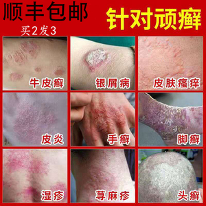 治牛皮癣断根银屑病药膏顽因藓去根皮肤全身干痒瘙痒特效专用药