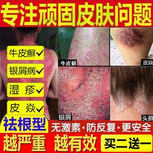 癣螨双1克复方黄柏祛癣喷剂牛皮癣药膏拔毒断癣王艾1贝儿狼毒癣克