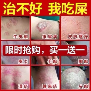 外用牛皮癣银屑病皮炎湿疹皮肤瘙痒药膏特效止痒抑菌专用头皮癣药