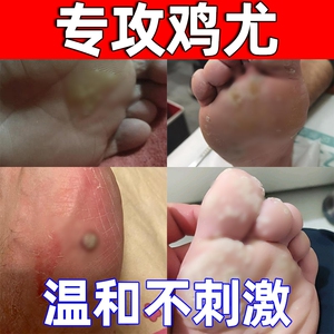 00晴怡精品小店淘宝刺猴去除正品鸡眼贴根日本点瘊子的根鱼鳞痣膏贴