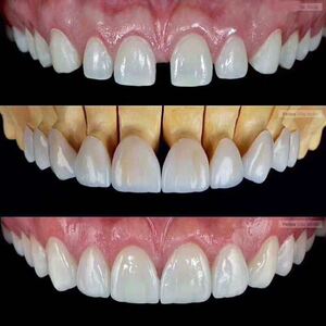 义获嘉超薄美白瓷贴面套装美加全瓷贴片烤瓷牙片遮盖假牙修复牙齿