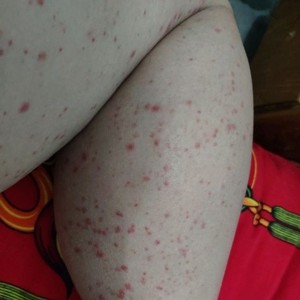 大腿根内侧皮肤肚子后背脖子皮毒净肤毒康苗医晚上痒皮肤外用软膏