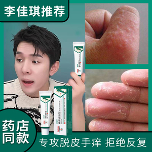 汗状疱疹专用软膏药膏泡手气膏蜕皮手指脱皮水泡烂手手藓真菌感染