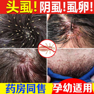 芙养灵虱净王虱子药儿童头虱百部酊成人用去阴虱除头虱喷剂虱立净