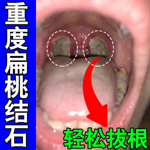 吸扁桃体结石的工具