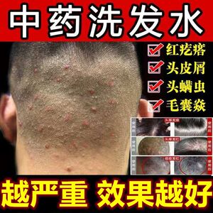 治疗毛囊炎头皮头部专用药严重疙瘩皮屑脂溢性皮去螨纯中药洗发水