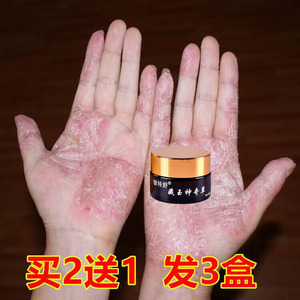 手蜕皮的药膏脱皮手足癣手掌掉皮肤湿疹止痒去根专用治疗冬季节性