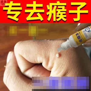 去猴子肉粒疙瘩去除颈部手上长疣跖尤刺猴肉刺肉赘瘊子药神器痦子