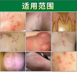 特效一扫光外用止痒疥虫灵去除疥螨虫阴虱结节灵藥膏疥灵霜0人付款28