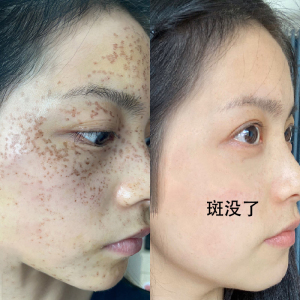 跟斑点说拜拜】去脸部各种顽固斑点斑迹 淡化脸上黑色素 男女可用