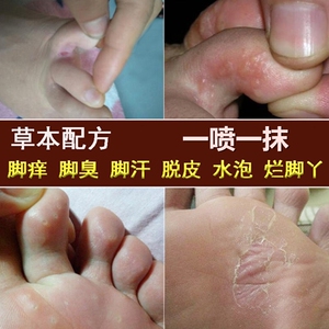 治疗脚气脚痒脱皮真菌感染水泡型糜烂去香港脚喷雾足癣喷剂脚丫