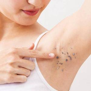 日本腋下美百色素沉淀磨砂膝盖手肘去死皮角质腋窝去异味去黑神器