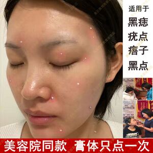 祛斑祛痣点痣的药膏药水去黑痣去痣无痕痦子祛疣雀斑专用点斑去除