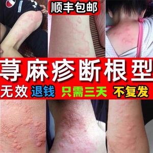 90同款货源彡倾听淘宝治疗牛皮廯藓银屑病止痒抑菌皮肤瘙痒湿疹去