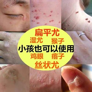 肉刺水猴子病毒传染性疣的专用药膏去祛除软疣儿童肉脖子手部