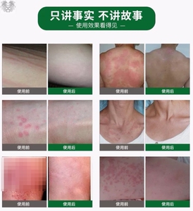 1g用于各种癣病的治疗头癣须癣体癣股癣足癣25人付款12.74康弘