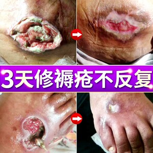 高端生部膏f坐用褥疮外疮膏玉红臀肌k去腐正品同仁堂伤口奢华
