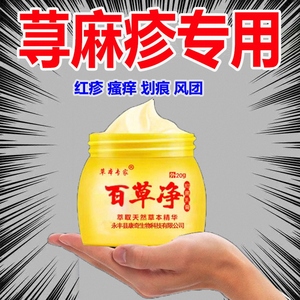 治疗儿童慢急性荨麻疹过敏止痒断根克星专用药皮肤瘙痒风团药膏