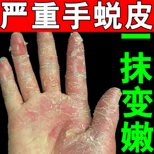 手脱皮药膏真菌感染治疗手上起小水泡干裂季节脱皮鹅掌风抑菌止痒
