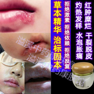 唇炎疱疹嘴巴嘴唇口嘴角药膏上火起泡干裂脱皮红肿痒修复羊胡子疮