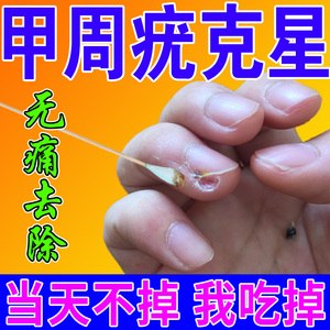 甲周疣专用药治手上长肉刺跖疣专用膏去根瘊疣偏方液态氮冷冻祛疣