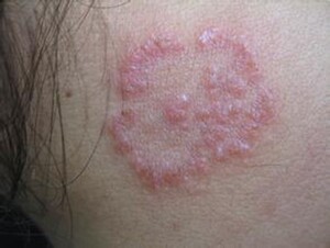 珍珠丘状诊去男女下面屁股丫丫大腿两侧裆部处皮阴囊潮湿下体蛋蛋