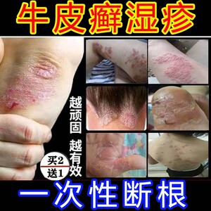 治牛皮癣银屑病专用药顽固止痒去根皮肤全身干痒阴囊瘙痒外用药膏