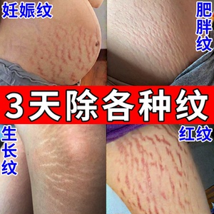 大腿肥胖纹消除修复霜