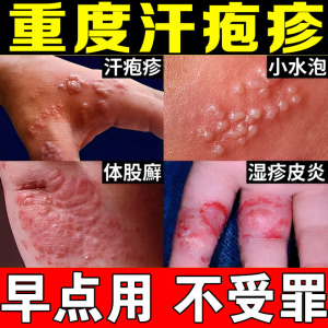 汗疱疱疹药膏手上起小水泡汗疱疹手癣止痒汗真菌感染顽固湿疹药膏