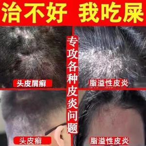 脂溢性皮炎去根除头皮癣头癣头皮屑头部面部外用软膏专用药膏