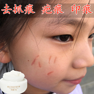 疤痕灵除疤凸起痘印烫伤祛疤膏去色素小孩儿童脸部指甲抓划痕伤疤