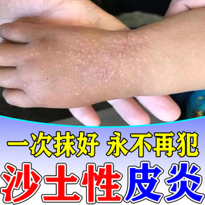 沙土性皮炎儿童柳絮杨絮花粉过敏特应性日光性皮炎去根珍珠状丘疹