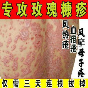 玫瑰糠疹专用药膏根除日光性皮炎紫外线晒伤湿疹脂溢性皮炎瘙痒
