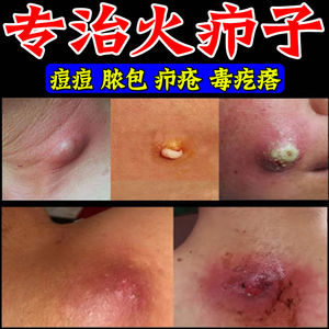 火疖子拨毒拔脓膏贴治疗痘痘痤疮消炎坐板疮屁股红肿硬块拔脓神器