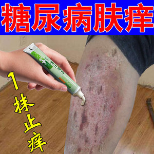 糖尿病皮肤痒止痒膏中老年人皮肤瘙痒全身干痒透析痒专用止痒神器